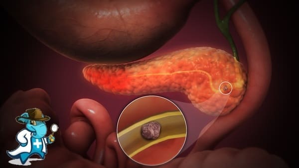¿Cubre el Seguro Médico la Pancreatitis en España?