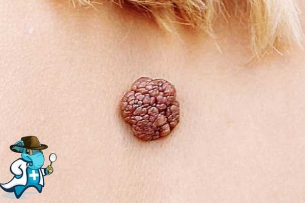 ¿Cubre el Seguro Médico los Acrocordones en España?