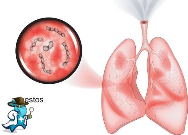 ¿Puedo Contratar un Seguro Médico si Tengo Asbestosis en España?