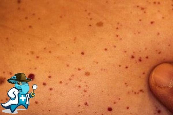 ¿Puedo Contratar un Seguro Médico si Tengo Enfermedad de Fabry en España?