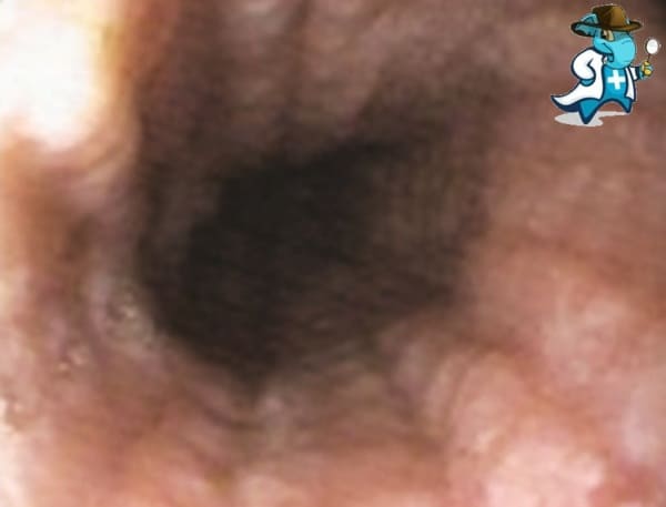 ¿Puedo Contratar un Seguro Médico si Tengo Esofagitis Eosinofílica en España?
