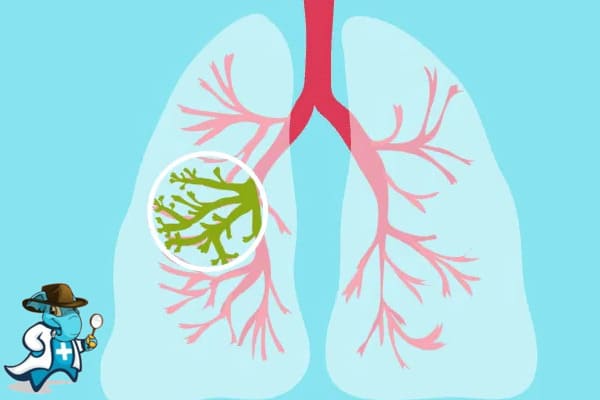 ¿Puedo Ocultar que Tengo Fibrosis Quística Para contratar el Seguro Médico en España?