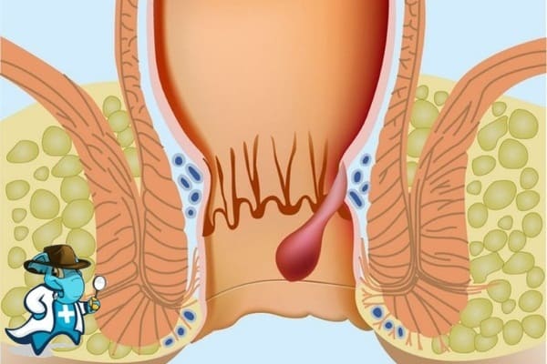 ¿Puedo Contratar un Seguro Médico si Tengo Hemorroides en España?