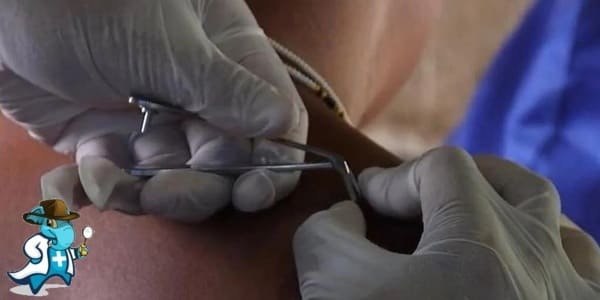 ¿Puedo Contratar un Seguro Médico si Tengo Oncocercosis en España?