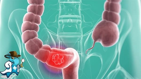 ¿Puedo Contratar un Seguro Médico si Tengo Sangrado Gastrointestinal en España?