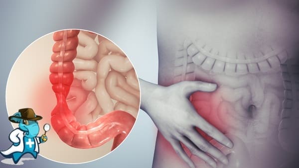 ¿Puedo Contratar un Seguro Médico si Tengo Síndrome de Intestino Irritable en España?