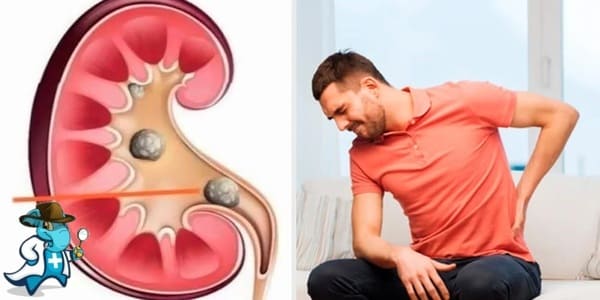¿Puedo Contratar un Seguro Médico si Tengo la Piedra en los Riñones en España?