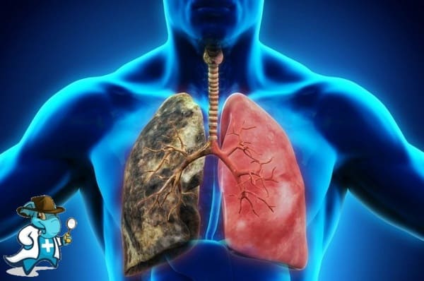 ¿Puedo Ocultar que Tengo Asbestosis Para Contratar el Seguro Médico en España?