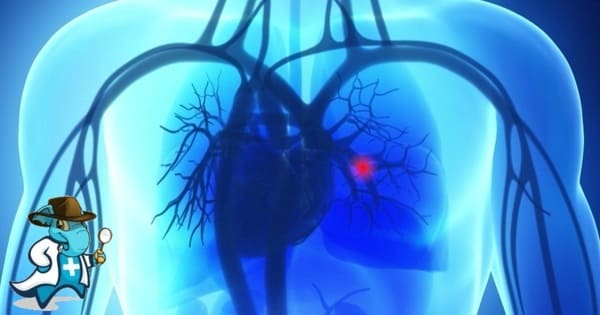 ¿Puedo Ocultar que Tengo Embolia Pulmonar Para Contratar el Seguro Médico en España?
