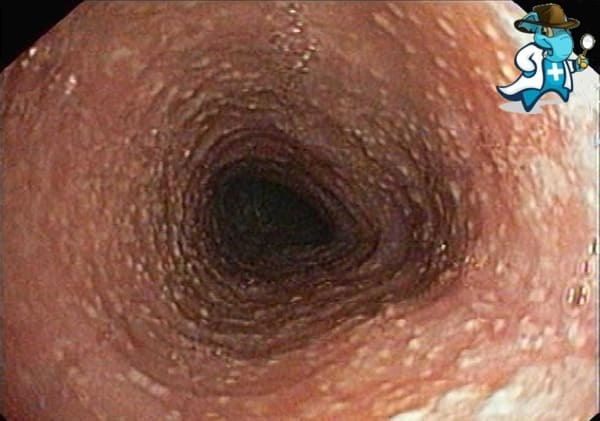 ¿Puedo Ocultar que Tengo Esofagitis Eosinofílica Para Contratar el Seguro Médico en España?