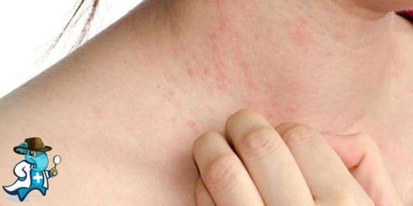 ¿Qué Exclusiones Tendría un Seguro Médico para una Persona con una Alergia a la Cebada en España?