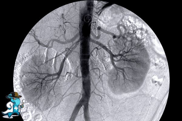 ¿Puedo Contratar un Seguro Médico si Tengo Enfermedad Renal Crónica en España?