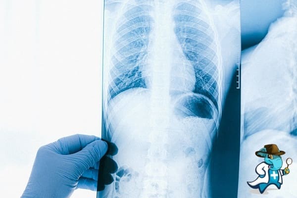 ¿Puedo Ocultar que Tengo Bronquiolitis Obliterante para Contratar el Seguro Médico en España?