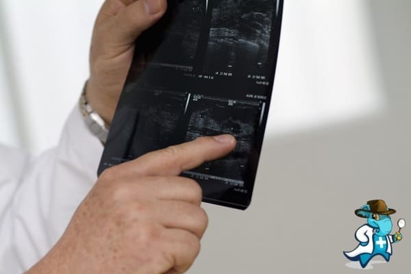 ¿Puedo Ocultar que Tengo Enfermedad Renal Poliquística para Contratar el Seguro Médico en España?