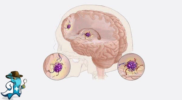 ¿Cubre el Seguro Médico el Angioma Cavernoso Cerebral en España?