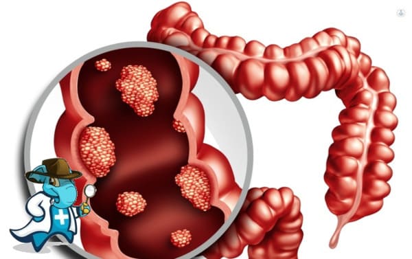 ¿Cubre el Seguro Médico el Cáncer Colorrectal en España?