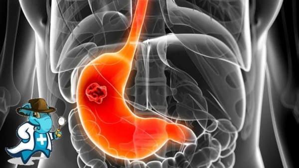 ¿Cubre el Seguro Médico el Cáncer de Estómago en España?