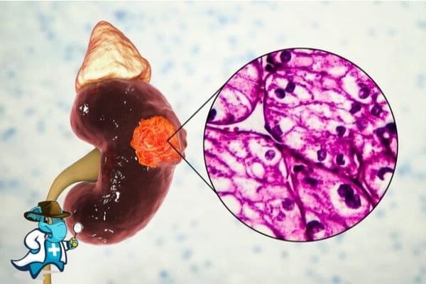 ¿Cubre el Seguro Médico el Carcinoma de Células Renales en España?