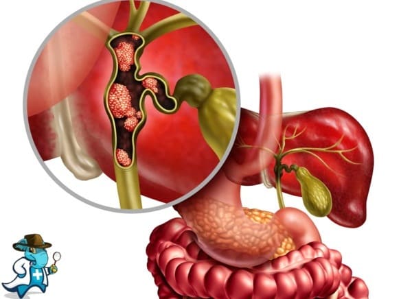¿Cubre el Seguro Médico el Colangiocarcinoma en España?