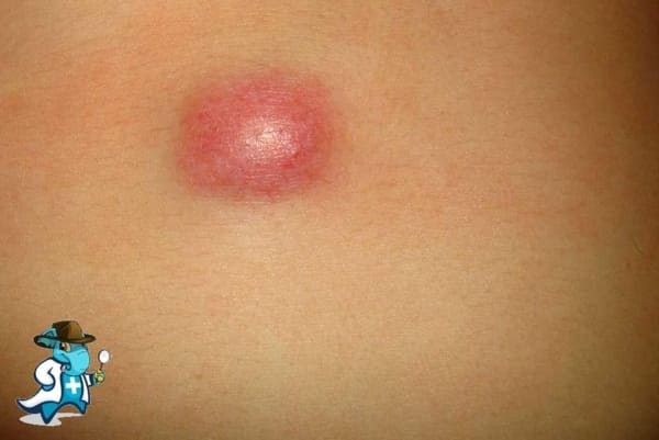 ¿Cubre el Seguro Médico el Dermatofibrosarcoma en España?