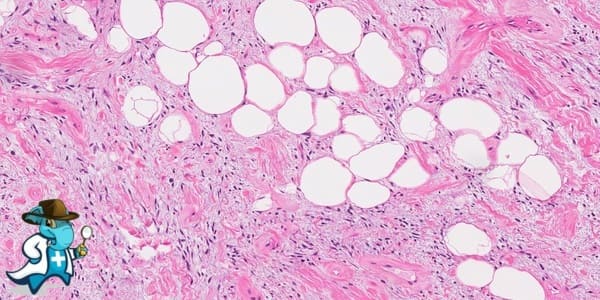 ¿Cubre el Seguro Médico el Liposarcoma Desdiferenciado en España?