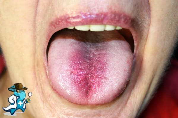 ¿Cubre el Seguro Médico el Síndrome de Boca Ardiente en España?