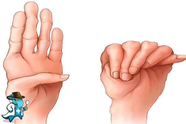 ¿Cubre el Seguro Médico el Síndrome de Marfan en España?