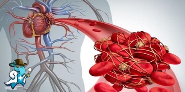 ¿Cubre el Seguro Médico el Trombo Embolismo Pulmonar en España?