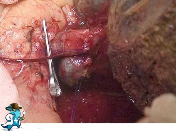 ¿Cubre el Seguro Médico el Tumor de Klatskin en España?