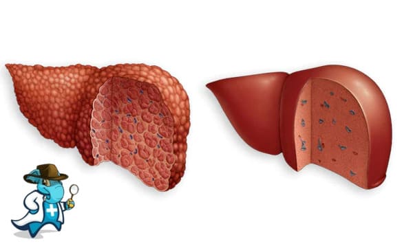 ¿Cubre el Seguro Médico la Cirrosis Hepática en España?