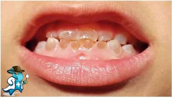 ¿Cubre el Seguro Médico la Dentinogénesis Imperfecta en España?