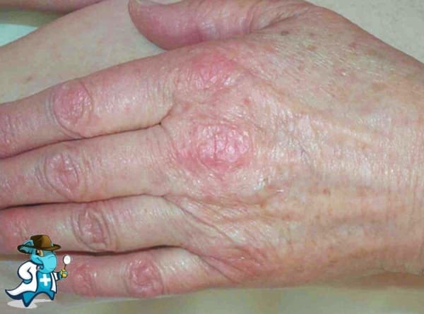 ¿Cubre el Seguro Médico la Dermatomiositis en España?