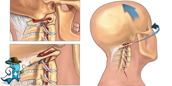¿Cubre el Seguro Médico la Disección Arterial Cervical en España?