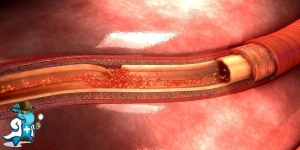 ¿Cubre el Seguro Médico la Disección de la Aorta en España?