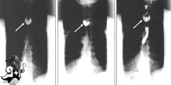 ¿Cubre el Seguro Médico la Disfagia Lusoria en España?