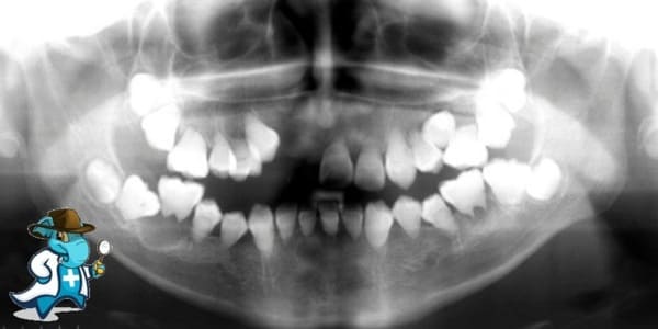 ¿Cubre el Seguro Médico la Displasia de la Dentina en España?