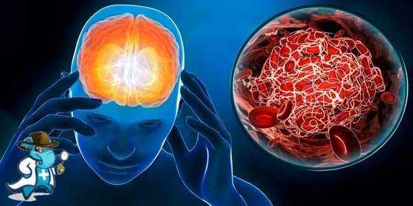 ¿Cubre el Seguro Médico la Enfermedad Cerebrovascular en España?