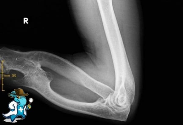 ¿Cubre el Seguro Médico la Enfermedad de Ollier en España?