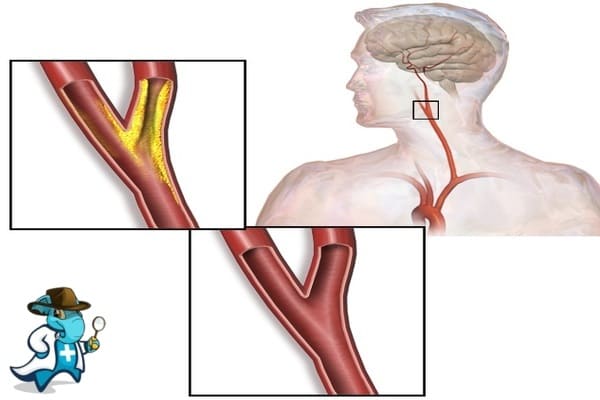 ¿Cubre el Seguro Médico la Estenosis de Arteria Carótida en España?