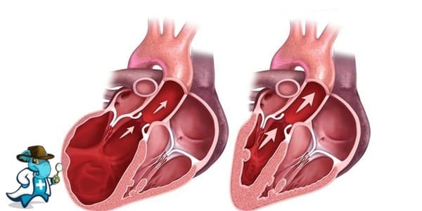¿Cubre el Seguro Médico la Miocardiopatía Hipertrófica en España?