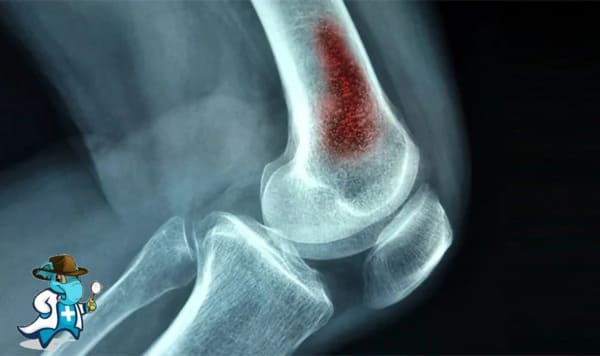 ¿Cubre el Seguro Médico la Osteomielitis en España?
