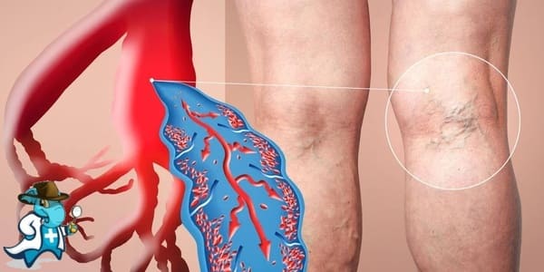 ¿Cubre el Seguro Médico la Trombosis Venosa en España?