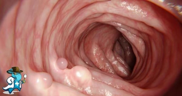 ¿Cubre el Seguro Médico los Pólipos de colon en España?