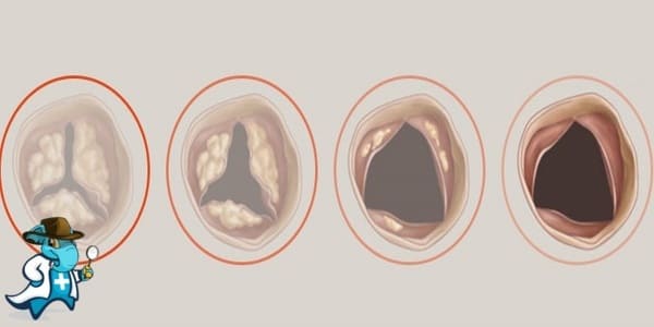 ¿Cubre el Seguro Médico la Estenosis Aórtica en España?