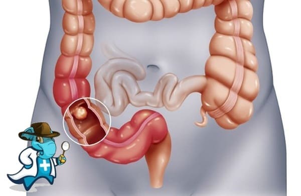 ¿Puedo Contratar un Seguro Médico si Tengo Cáncer Colorrectal en España?