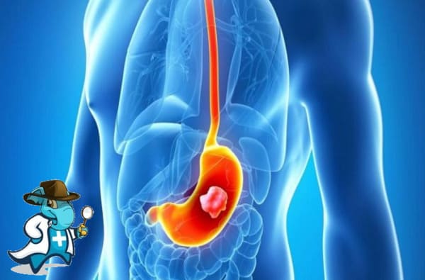 ¿Puedo Ocultar que Tengo Cáncer de Estómago Para Contratar el Seguro Médico en España?