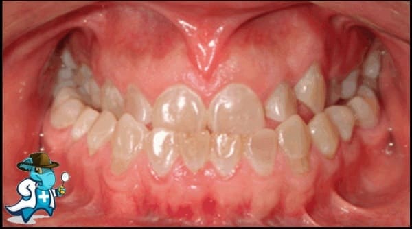 ¿Puedo Contratar un Seguro Médico si Tengo Dentinogénesis Imperfecta en España?