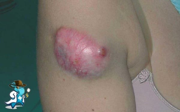¿Puedo Contratar un Seguro Médico si Tengo Dermatofibrosarcoma en España?