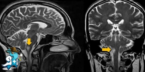 ¿Puedo Contratar un Seguro Médico si Tengo Disección Arterial Cervical en España?