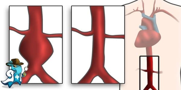 ¿Puedo Contratar un Seguro Médico si Tengo Disección de la Aorta en España?